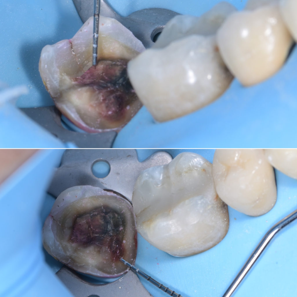 Photo showing Caries Removal Endpoints (CRE)