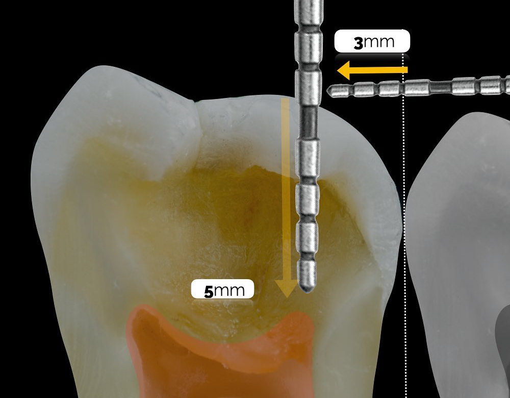 Photo illustrating Caries Removal Endpoints