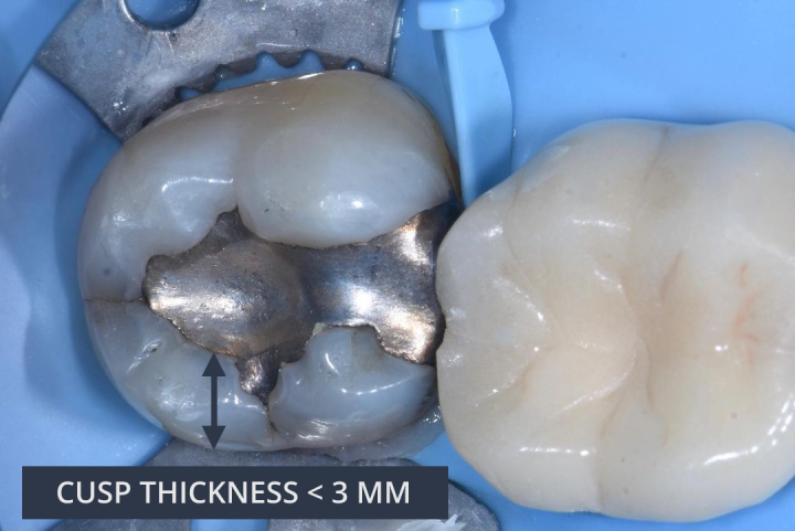 Photo showing Cusp Thickness - Lesson 2