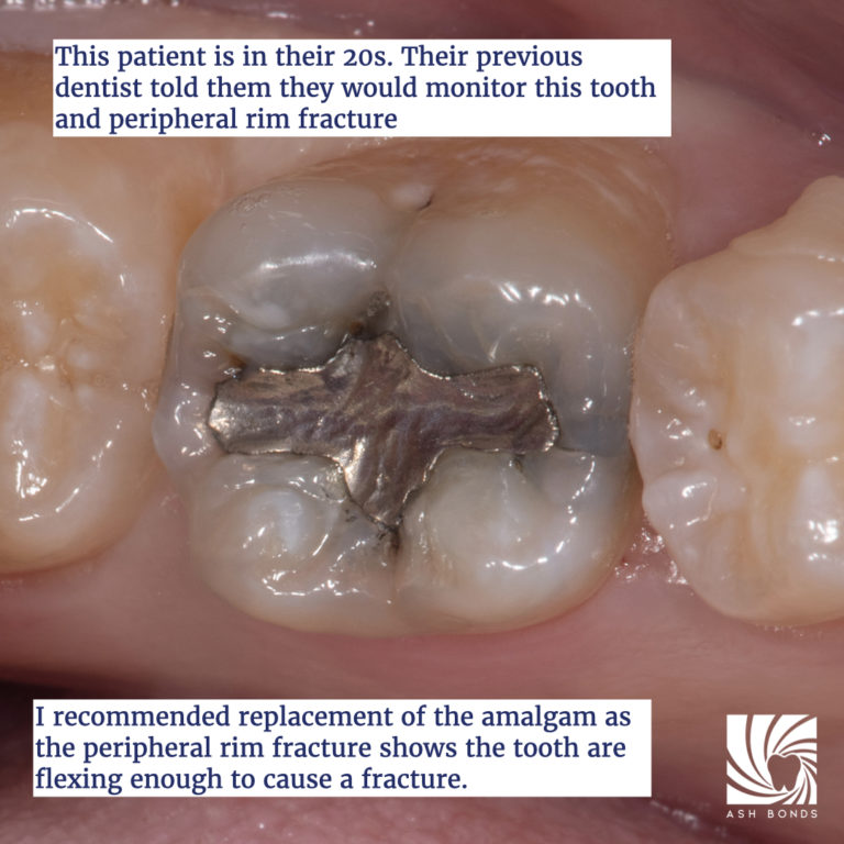 Occlusal Effect Caries (OEC) - The Hybrid Layer