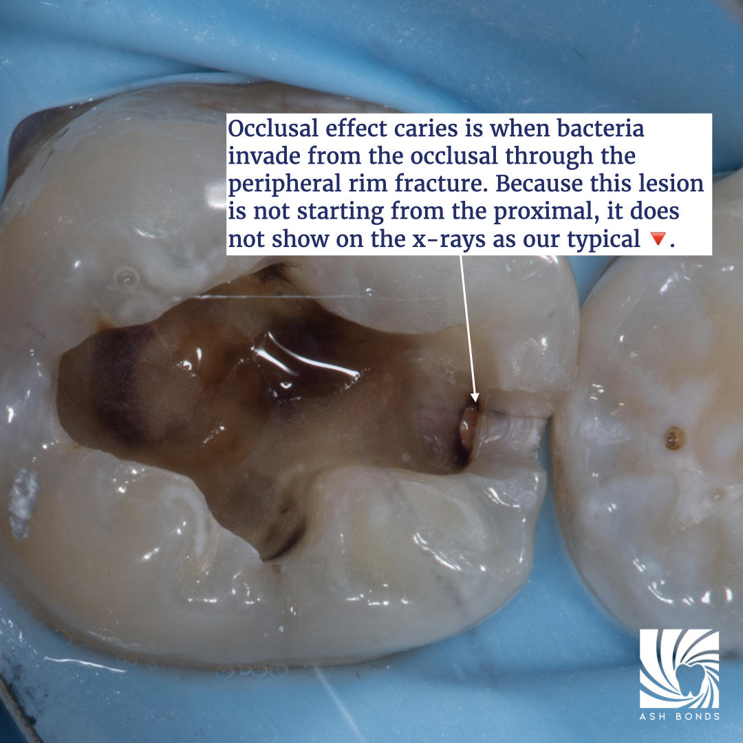 Occlusal Effect Caries (OEC) The Hybrid Layer