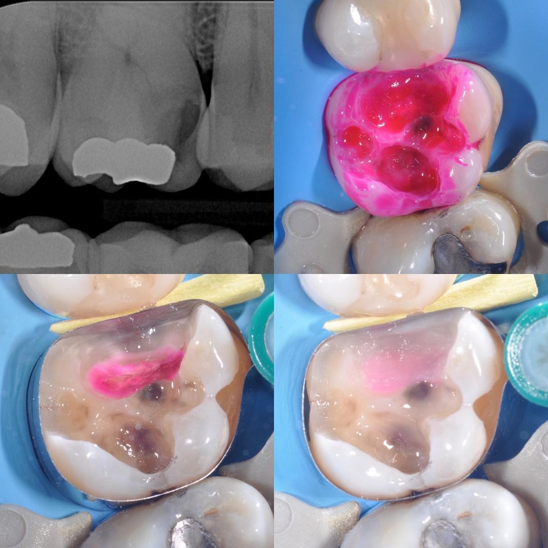 Lesson 1 Diagnosis and Treatment of Caries The Hybrid Layer