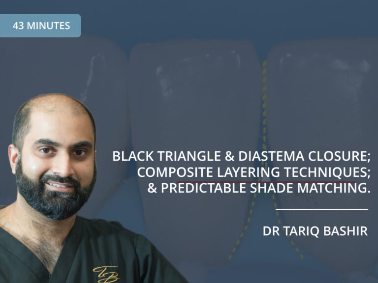 Black Triangle and Diastema Closure; Composite Layering Techniques; and Predictable Shade Matching – Dr Tariq Bashir